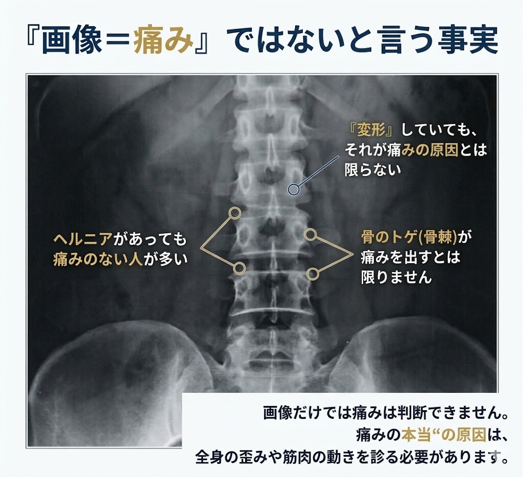 ヘルニアが直接の原因ではないことをレントゲン画像で説明