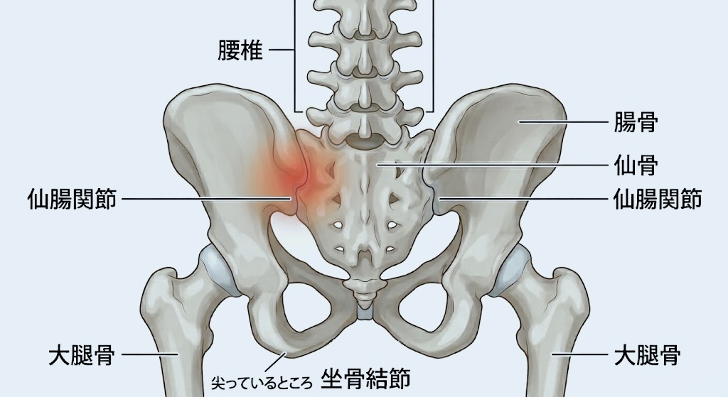 ヘルニアとよく似た骨盤片側の腰痛について